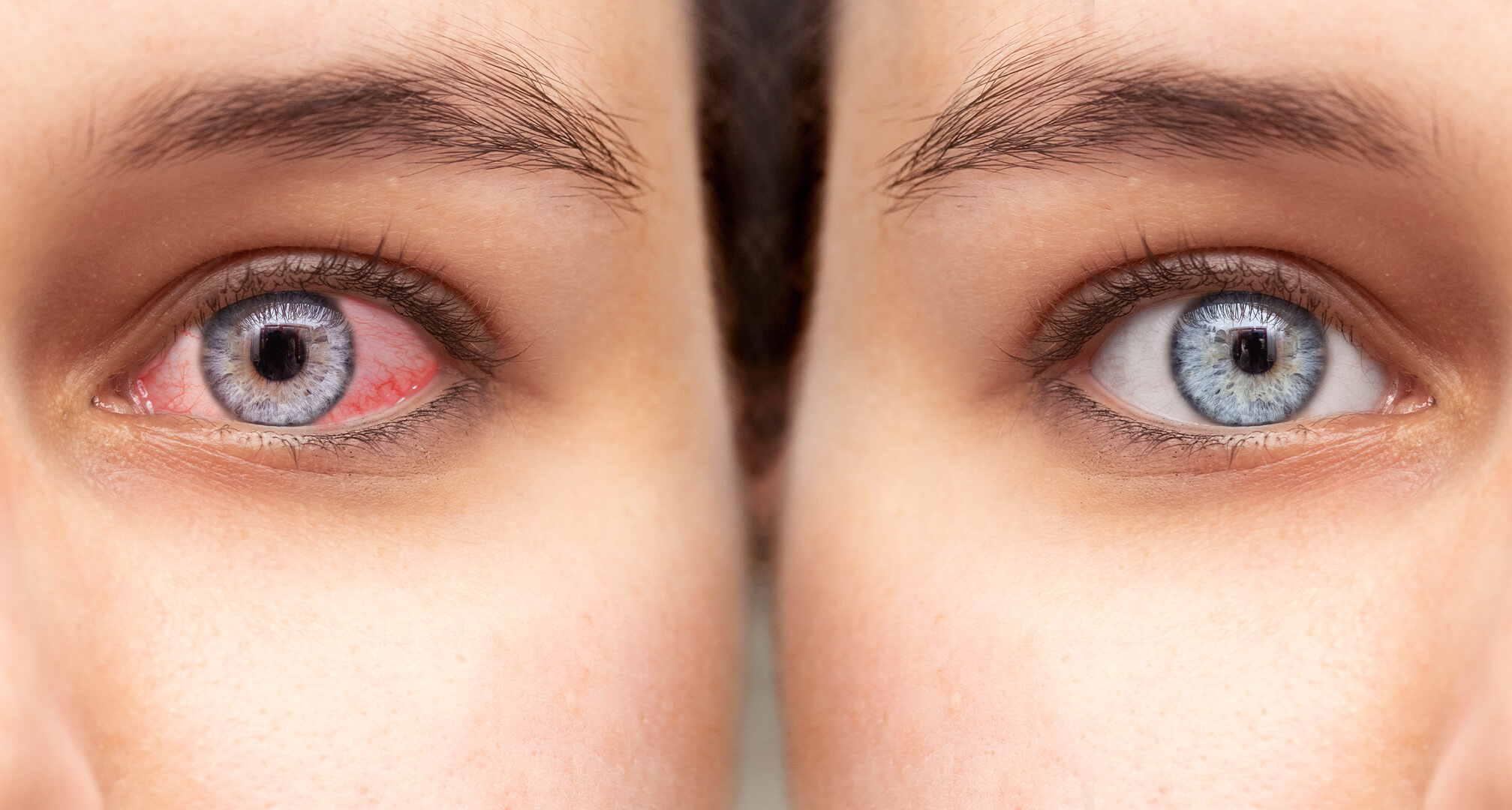 närbild av två ögon sida vid sida, ett rött torrt öga till vänster och ett friskt öga till höger