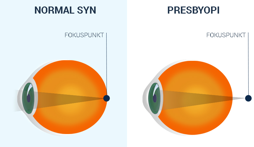 Presbyopia