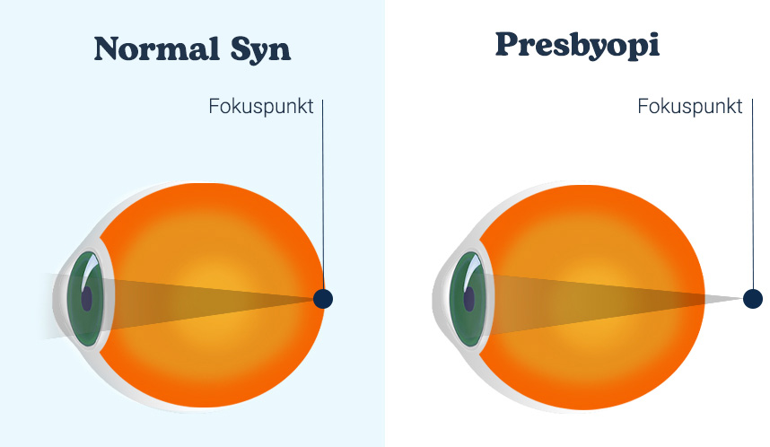 bild av en fokuspunkt i ett normalt öga och i ett öga med presbyopi