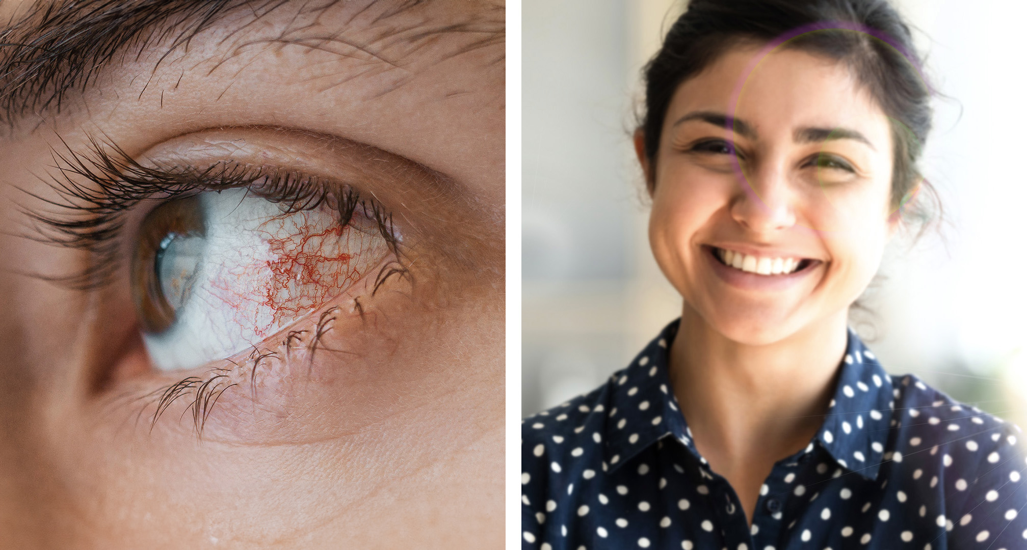 Fotokeratit kan leda till röda eller blodsprängda ögon (vänster). Även om det inte alltid är fallet kan det leda till suddig syn eller symtom som att man ser halos i synfältet (höger).