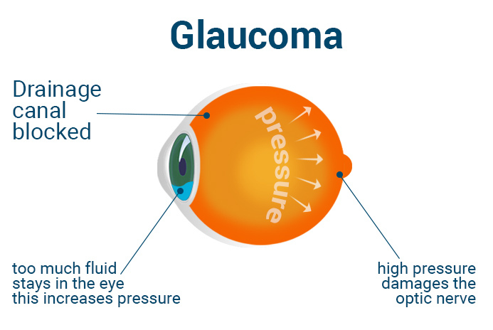 Glaucoma eye