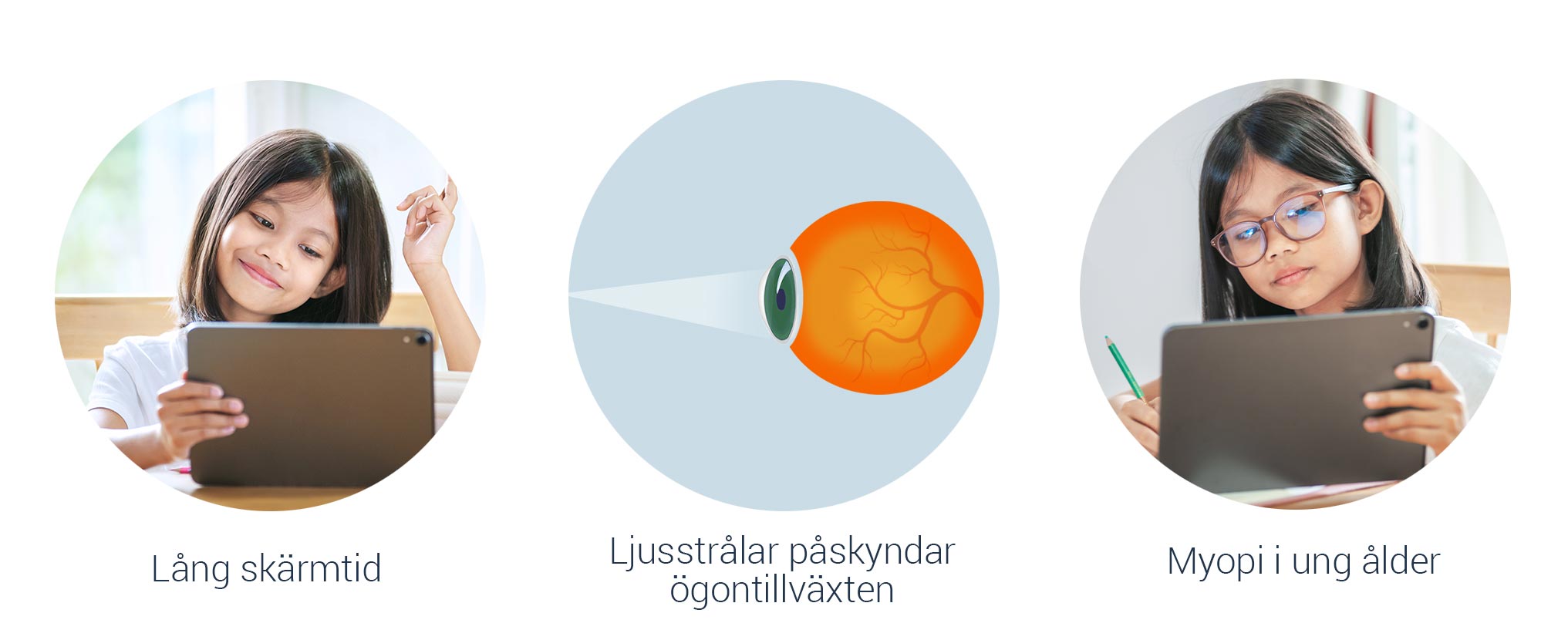 Vad orsakar närsynthet (myopi) hos barn?