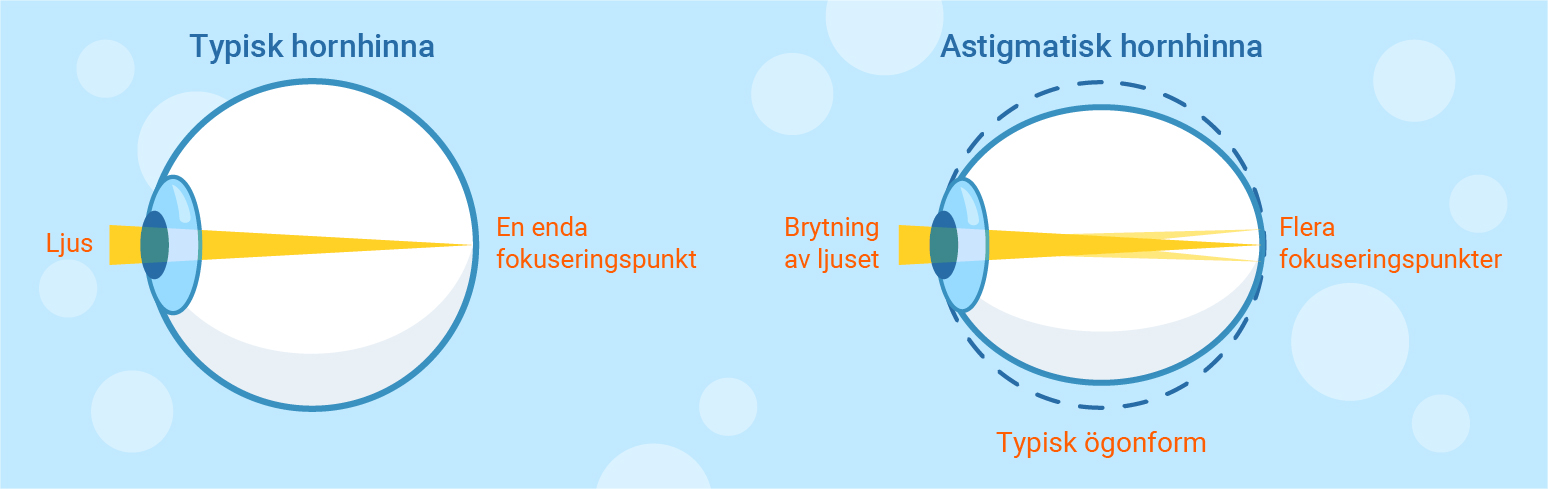 typisk samt astigmatisk hornhinna