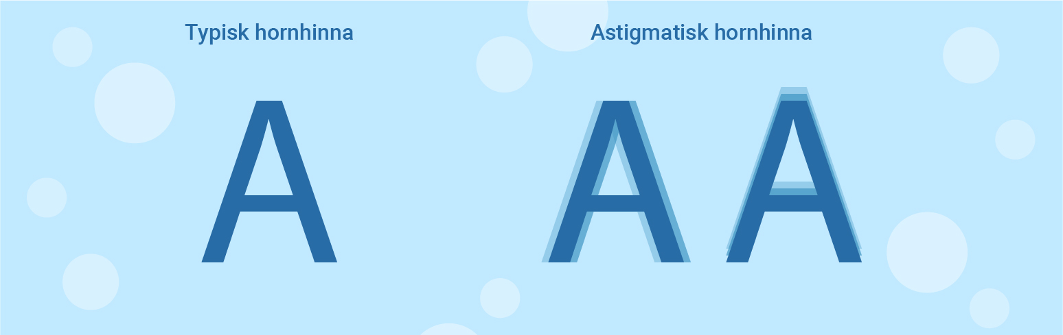 typisk samt astigmatisk hornhinna