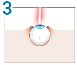 Lasik, step 3